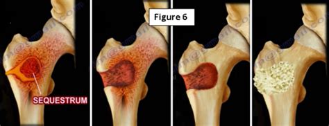 Osteomyelitis | HuffPost