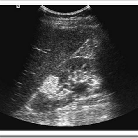 Ultrasound images of Angiomyolipoma - Radiology Imaging