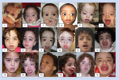 Phenotype and natural history in Marshall-Smith syndrome. | Semantic Scholar