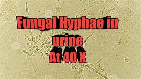 Fungal hyphae in urine microscopy at 40X - YouTube