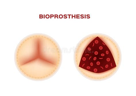 Bioprosthesis and an Aortic Valve Replacement Vector Stock Vector ...