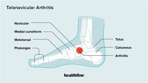 Talonavicular Arthritis: Symptoms, Causes, Diagnosis, Treatment