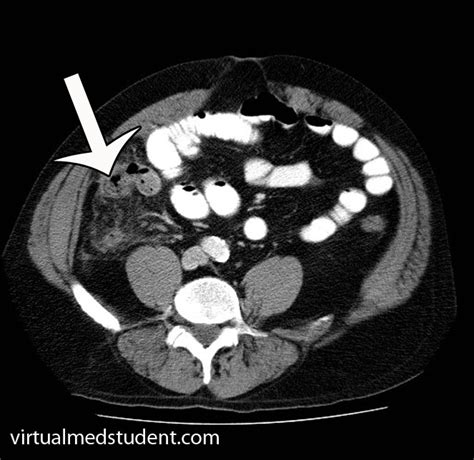 Appendix Ct Scan