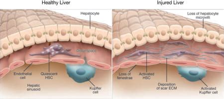 Hepatic Stellate Cells | Yin Lab