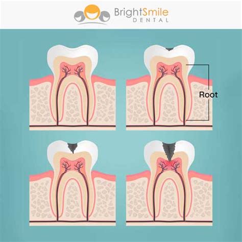 Most Common Root Canal Symptoms - Bright Smile Dental Powell