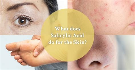 Salicylic Acid: Learn all About the Benefits for the Skin