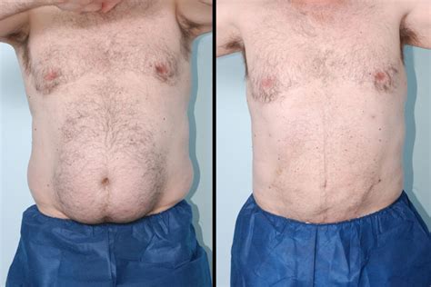 Liposuction Salt Lake City | Gateway Aesthetic