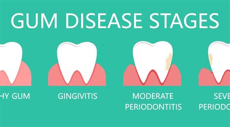 How is periodontal disease treated by your dentist? - TC Dental Group