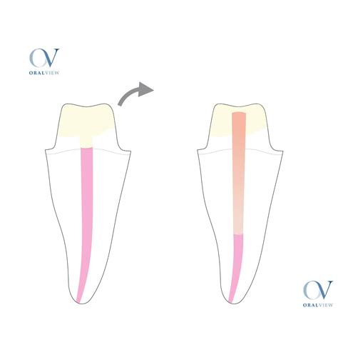 ᐈ El Ferrule dental o efecto ferrule ⭐