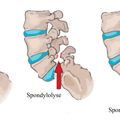 Lumbar Spondylitis (Degeneration) | Sanjay Hospital | Palani