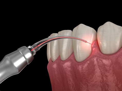 Laser Periodontal Therapy | Accent Smile Center