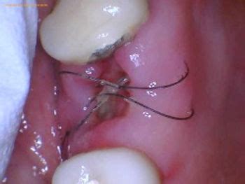 Is It Normal For Dental Stitches To Fall Out? Exploring Post-Surgery Healing ...