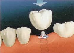 Titanium Implants Teeth - Teeth Implants