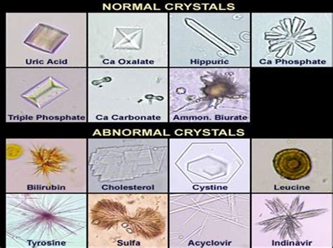 Urine Crystals Forms | Medical Laboratories