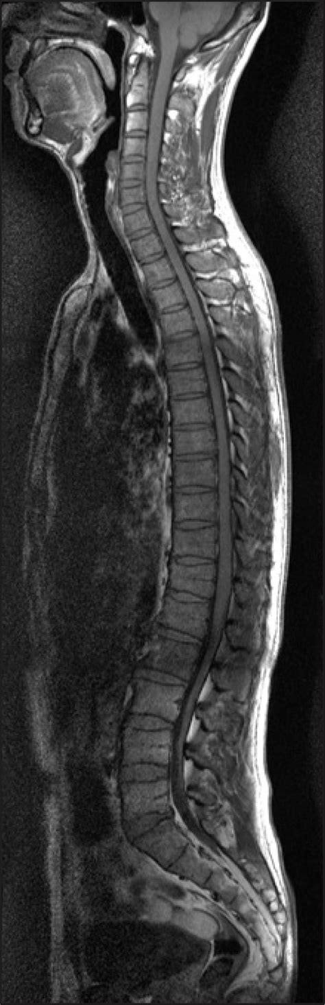 Whole Spine MRI, HD#1. Anterior wedging at T12 and L1, disc ...