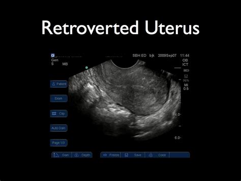 MaidadyCerminara: Kidney cancer Ultrasound pix