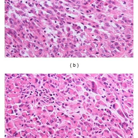 Histological findings. (a) Proliferation of spindle cells with abnormal... | Download Scientific ...