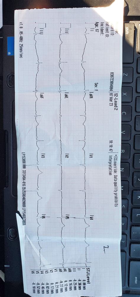 Found a cool Osborn wave. : r/EKGs