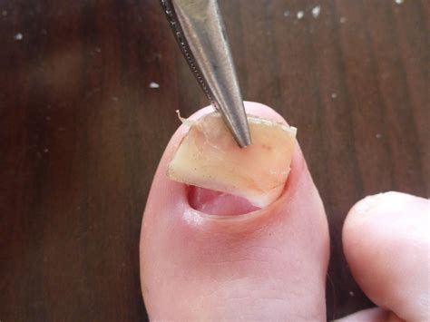 DIY Toenail Removal – not for the weak of stomach! – Singletrack Magazine