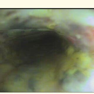 Erythematous esophageal mucosa with superficial ulcerations classified... | Download Scientific ...