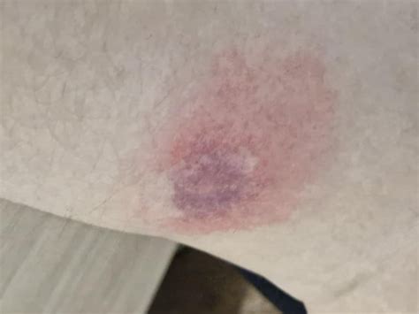 Mosquito bites?? : r/bugbites