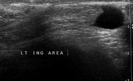 Hydrocele of the canal of Nuck | Radiology Reference Article | Radiopaedia.org