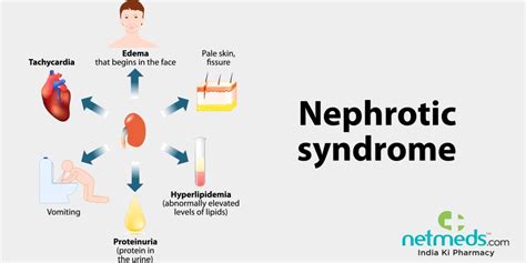 Nephrotic Syndrome: Causes, Symptoms And Treatment