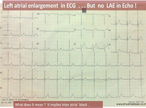 Atrial Enlargement On Ekg