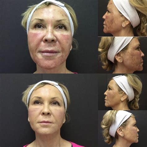 Chemical Peel results comparable to Fraxel Laser | Cynthia Golomb, MD ...