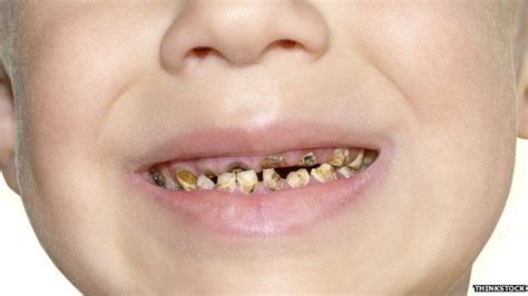 Child tooth removal 'at crisis point', doctors warn - BBC News