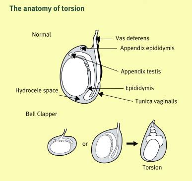 Pain and swelling of the scrotum, epididymitis and torsion - Surgery - Oxford International Edition