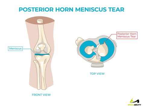 Pain Behind Knee | Why it Hurts in Back of or Under your Kneecap