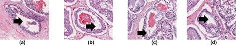 The central lumen of the tubule in different breast histopathological... | Download Scientific ...