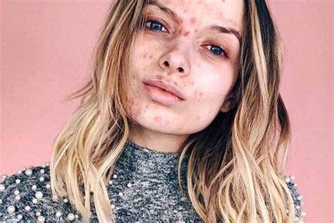 12 Beautiful Pictures of Acne Scars