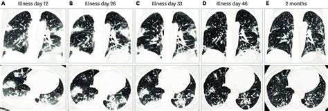 Chest high-resolution computed tomography (HRCT) (A) Chest HRCT on ...