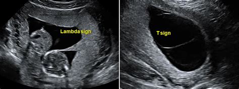 T Sign In Twin Pregnancy Seen In : Prenatal diagnosis of chorionicity determination in twin ...