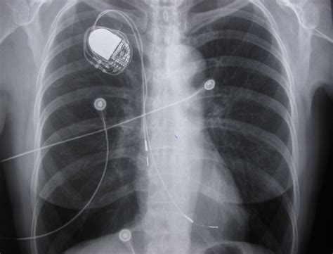 Early Complications After Pacemaker Implantations | IntechOpen