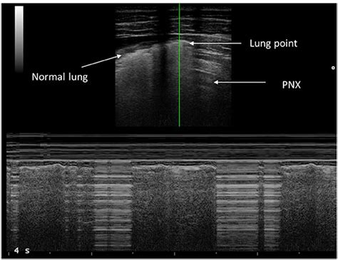 Frontiers | Lung Ultrasound to Detect Pneumothorax in Children ...