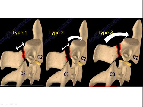 Hangman Fracture Classification — OrthopaedicPrinciples.com