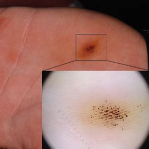 Brown-Black Punctate Macule on the Left Palm | MDedge Dermatology