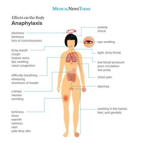 Anaphylaxis: Signs, causes, and treatment | Anaphylaxis, Treatment for ...