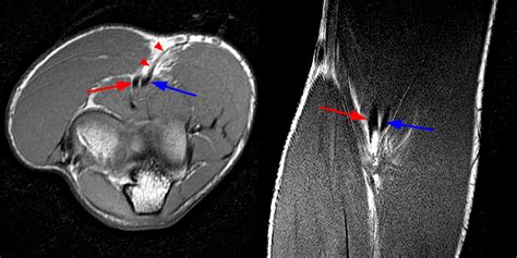 Biceps Tendon Tear Elbow Mri