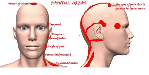 Marma & Ayurveda Chikitsa: Role of posture in the manifestation of Occipital pain/neuralgia ...