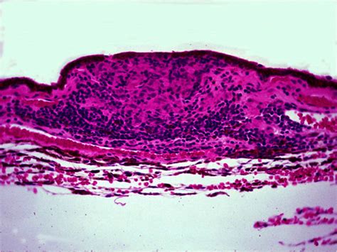 Histopathology of a Dalen-Fuchs nodule. There is an accumulation of ...