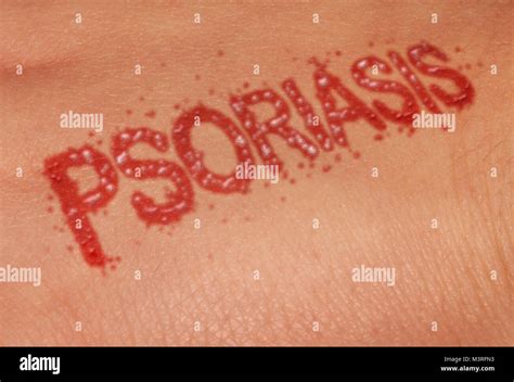 Psoriasis autoimmune disease as dry red skin patches as a symbol for dermatology illness in a 3D ...