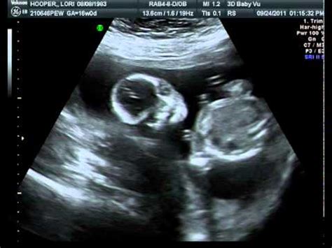 16 Week Ultrasound / Gender Determination - YouTube