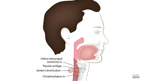 HCC 1475-2f2-Pathology of Esophagus - Zenkers diverticulum - YouTube