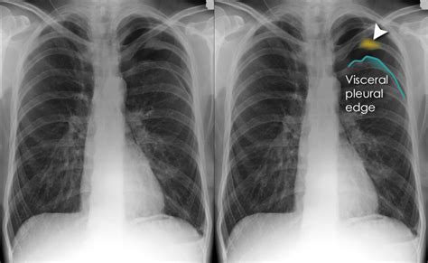 Chest X Ray Pleural Effusion Interpretation