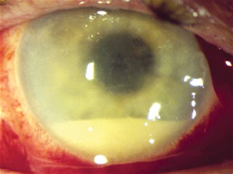 Heading Off Acute Postop Endophthalmitis