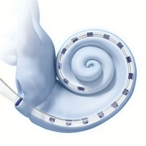 Internal Components of a Cochlear Implant | Advanced Bionics Advanced ...